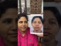 Rhinoplasty Before After
