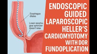 e-LHCM(ENDOSCOPIC GUIDED LAPAROSCOPIC HELLER'S CARDIOMYOTOMY WITH DOR FUNDOPLICATION)