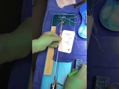 Quad Tendon Autograft ACL Graft Marks