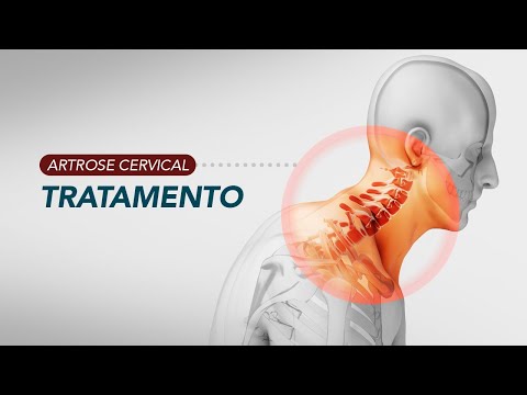 Artrose cervical - Tratamento