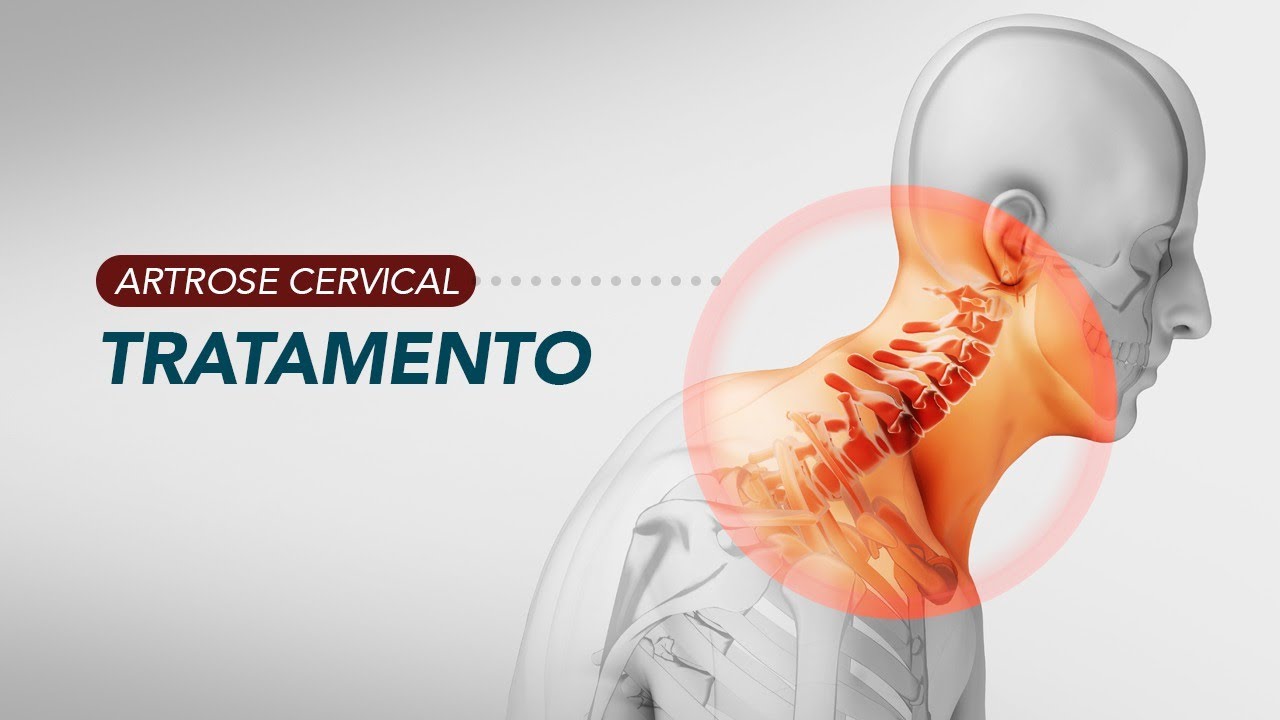 Artrose cervical - Tratamento