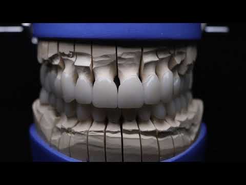 Rebuilding Your Smile – All-On-X Dental Implants for Full Arch Restoration in Los Algodones, Mexico