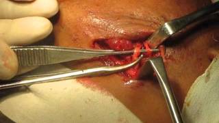 lower jaw fracture or mandibular fracture bone plating.wmv