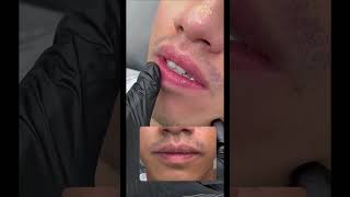Dark Lip Correction for Men