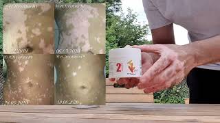 VT 1 Cream for Vitiligo Stage 1
