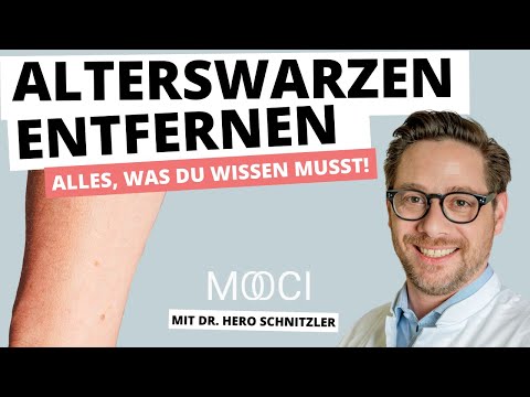 Wie kann man Alterswarzen entfernen?