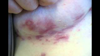 2012-03-31 16.08 CID Hidradenitis Suppurativa