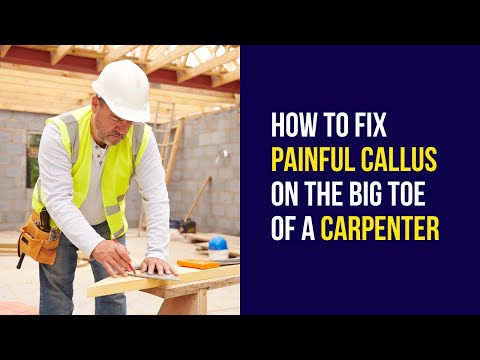 HOW TO FIX Painful CALLUS on the big Toe of a Carpenter