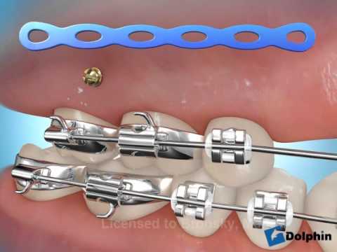 Conseil vidéo orthodontie