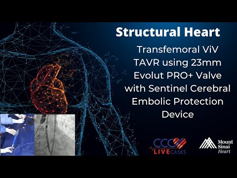 Transfemoral ViV TAVR using 23mm Evolut Pro+ Valve - May 2021