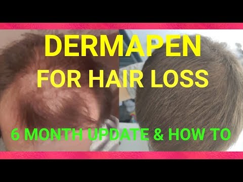 Micro Needling for Hair Loss - How I Use My Derma Pen