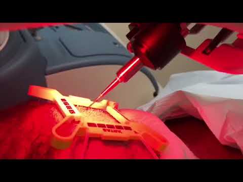 LIVE ARTAS Robotic Hair Transplant Procedure - ARTAS in Action