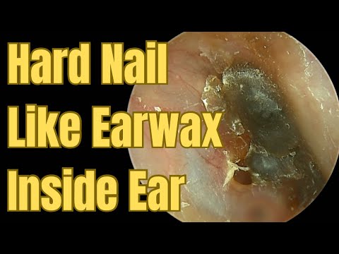 Hard Nail Like Earwax Inside Ear