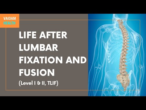 Life After Lumbar Fixation and Fusion (Level I & II, TLIF)