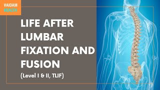 Life After Lumbar Fixation and Fusion (Level I, II and TLIF)