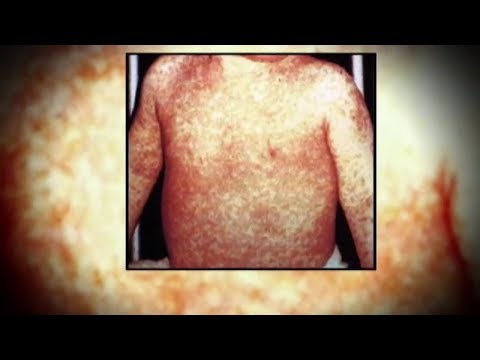 NJ Ocean County Measles Outbreak