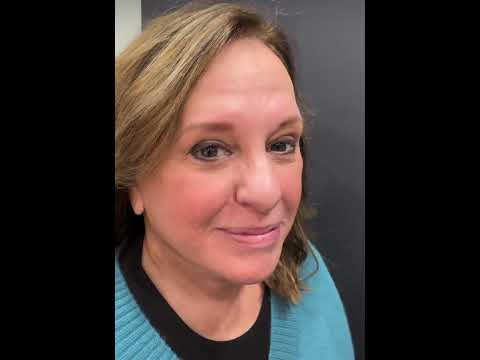 Deep Plane Facelift + Deep Neck Lift | Day 13 Before & After