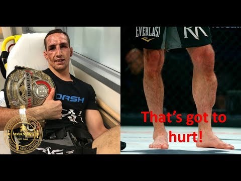 MMA: Rory MacDonald says leg injury against Douglas Lima was worst pain he’s felt in a fight