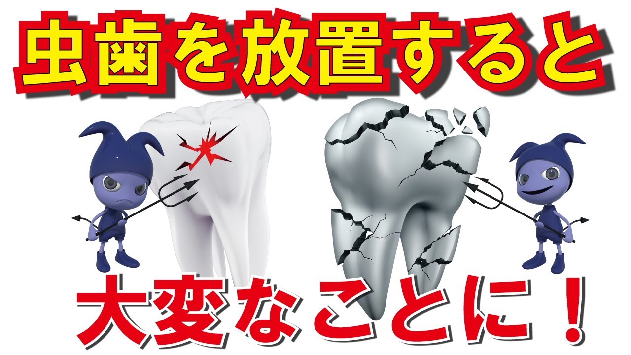 放置された重度のむし歯の治療!! Treatment For Severe Tooth Decay !!