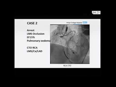 SCAI Joint Session 2017 CTO PCI Technique and Clinical Update