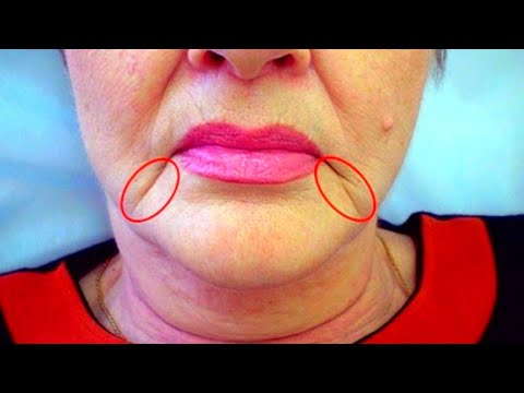 Marionette Lines ? | How To Get Rid of Marionette lines And Lift Up Lips Corners With Massage