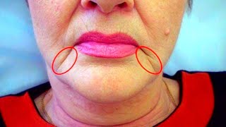 Marionette Lines ? | How To Get Rid of Marionette lines And Lift Up Lips Corners With Massage