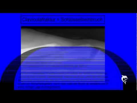 Arthroskopische Chirurgie auf dem Schultergelenk Bewertungen Rauchen und Rückenschmerzen