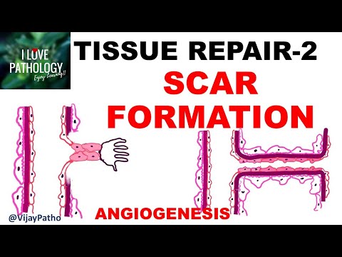 TISSUR REPAIR Part 2: Repair by SCAR formation.  ANGIOGENESIS, GRANULATION TISSUE, TISSUE REMODELING