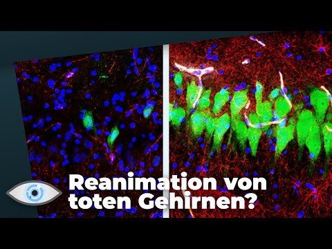 Wie tot ist Hirntod? - Können “tote Gehirne” reanimiert werden?