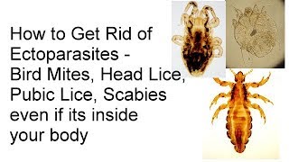 How to Get Rid of Lice, Pubic Lice, Scabies, Bird Mites, Ectoparasites even if its inside your body