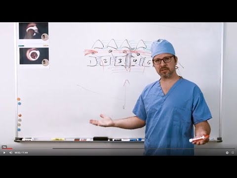 Minimally Invasive Transforaminal Lumbar Interbody Fusion - The Procedure