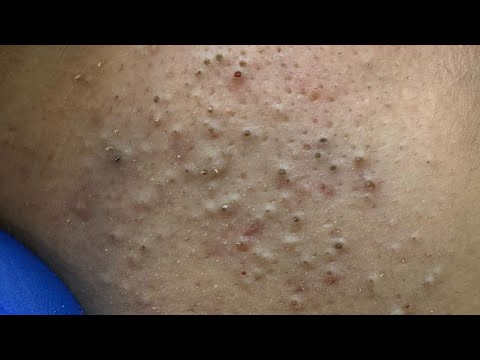 Tiefenreinigungstechniken – Erstaunliche Gesichtspflegeroutine zur Akneentfernung