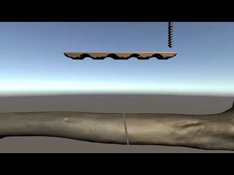 Bone Screw and Plate Animation with Unity 3D 2020.1