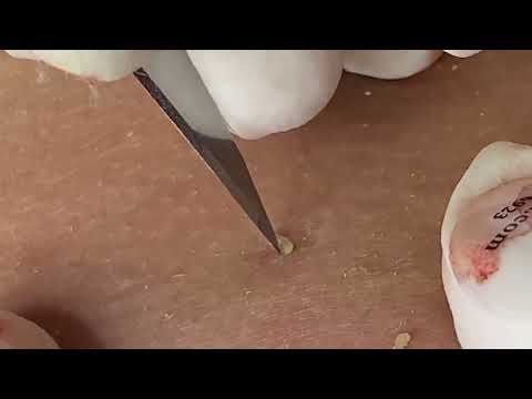Relaxing ASMR and Blackhead Removal