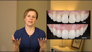 Triángulos negros (troneras)