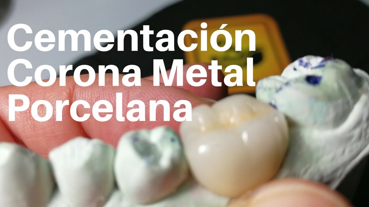 CORONA DENTAL👅Metal Porcelana #coronadental