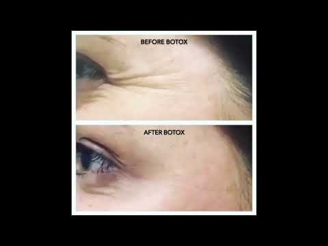 Botox Treatment: Before + After - YouTube