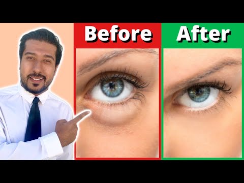 How to Get Rid of Puffy Eyes and Bags in 5 Fast Steps