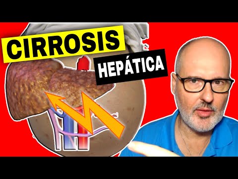 CIRROSIS HEPÁTICA 💥 Causas, Síntomas y Tratamiento