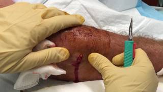 Arm infection and SEPSIS