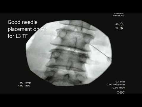 Lumbar transforaminal epidural injection with incorrect needle placement and live contrast spread