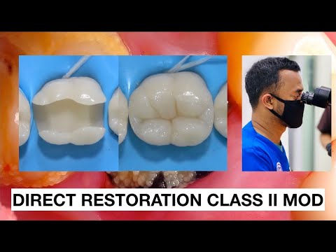 Direct Restoration Class II Composite | Practice