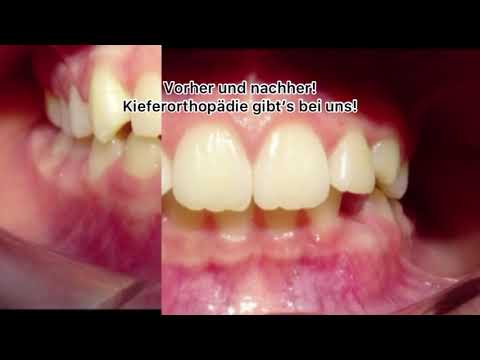 Kieferorthopädie gibt’s bei uns! #geradezähne #kieferorthopädie #recklinghausen #zahnklinik