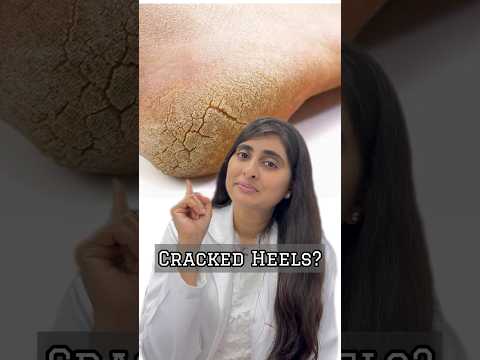 How to treat cracked heels | Cracked heels treatment | Foot cream for cracked heels