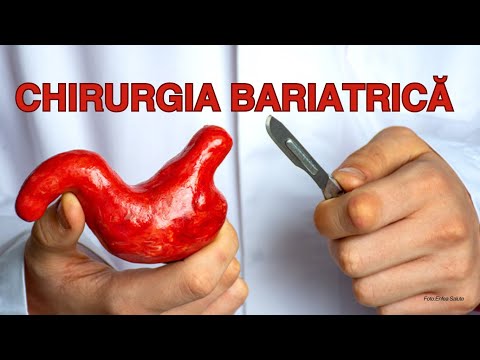 Operația de micșorare a stomacului. Tipurile de intervenții utilizate pentru tratarea obezității