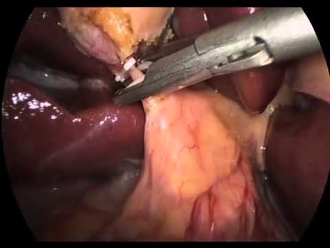 Laparoskopowa cholecystektomia i biopsja wątroby z powodu polipu pęcherzyka żółciowego i zapalenia wątroby