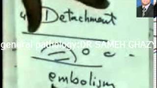 general pathology16 :embolism thrombus DR SAMEH GHAZY