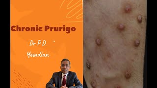Chronic prurigo/Nodular prurigo/Prurigo nodularis