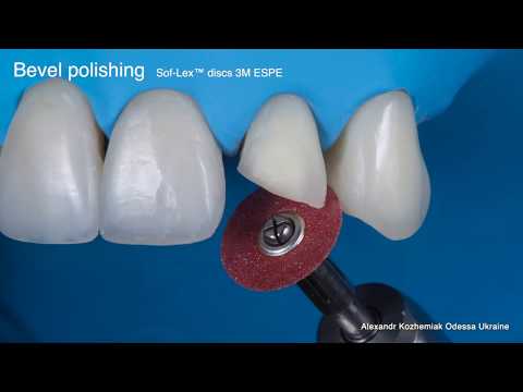 Direct restoration of frontal teeth, finishing & polishing