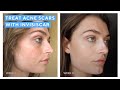 The 101 On InvisiScar Resurfacing Treatment | Reduce Acne Scars | Murad Skincare